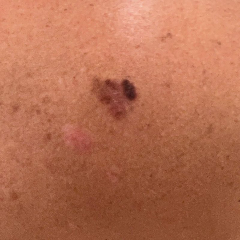 RHOBH Teddi Mellencamp Has a Skin Cancer Scare 2