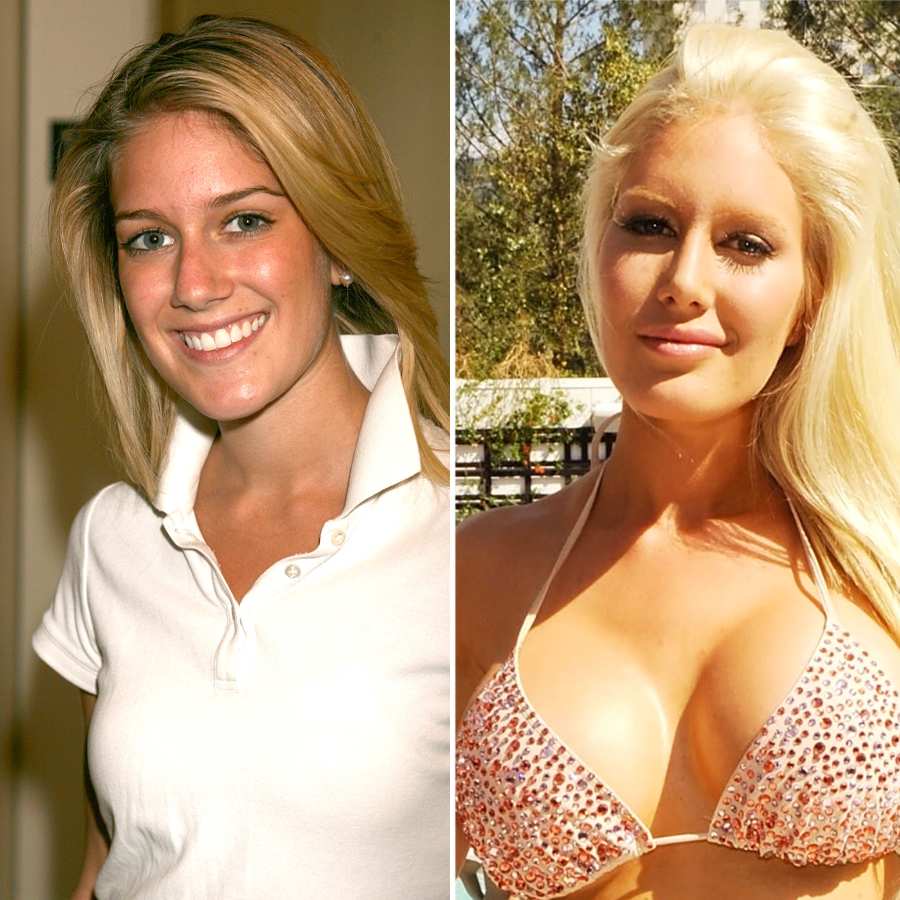 Breast Augmentation Before and After Photo Gallery