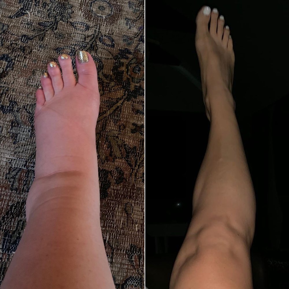 top-100-images-pictures-of-swollen-ankles-due-to-liver-problems-superb