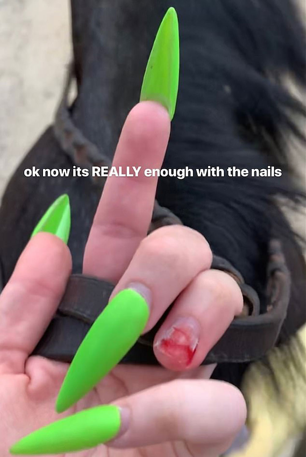 Yikes! Billie Eilish Accidentally Just Ripped Off Her Nail | Best