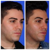 Marc Before After Facial