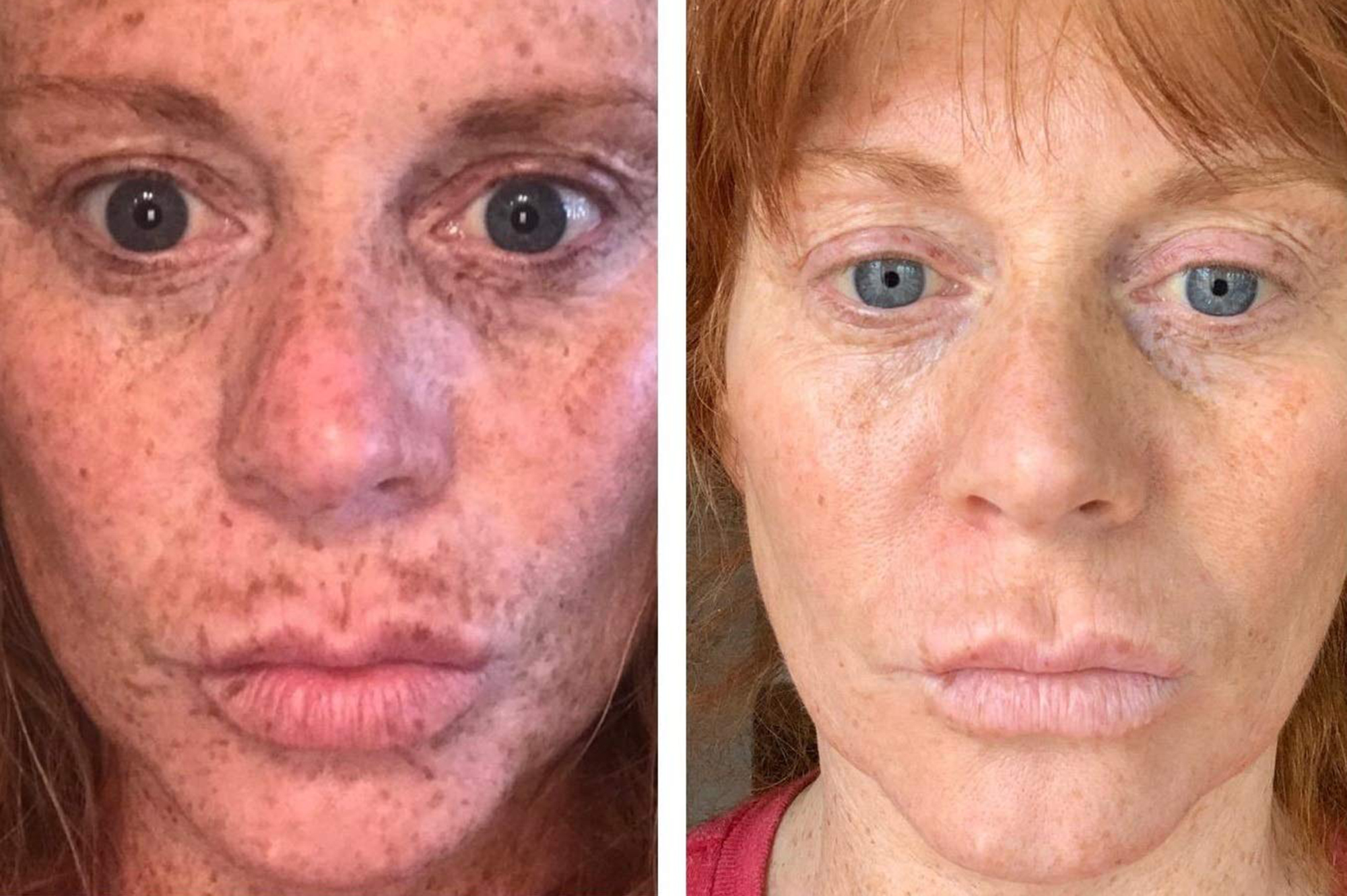 hydroquinone freckles before and after