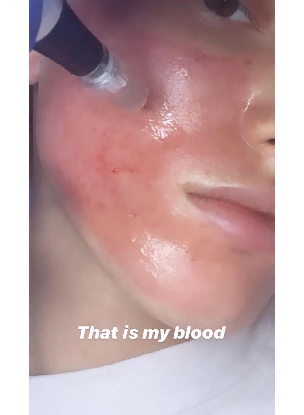 Bella Thorne’s Skincare Treatment Details: '12 Needles Going Into My Face'