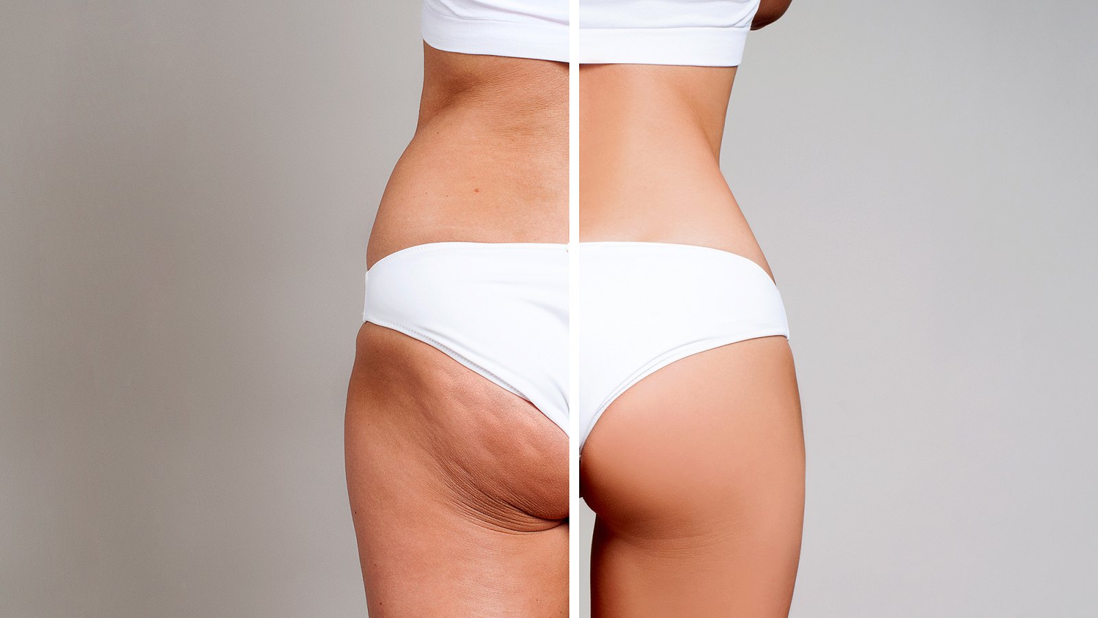 One simple anti-cellulite treatment and the aftercare - RECOVA®