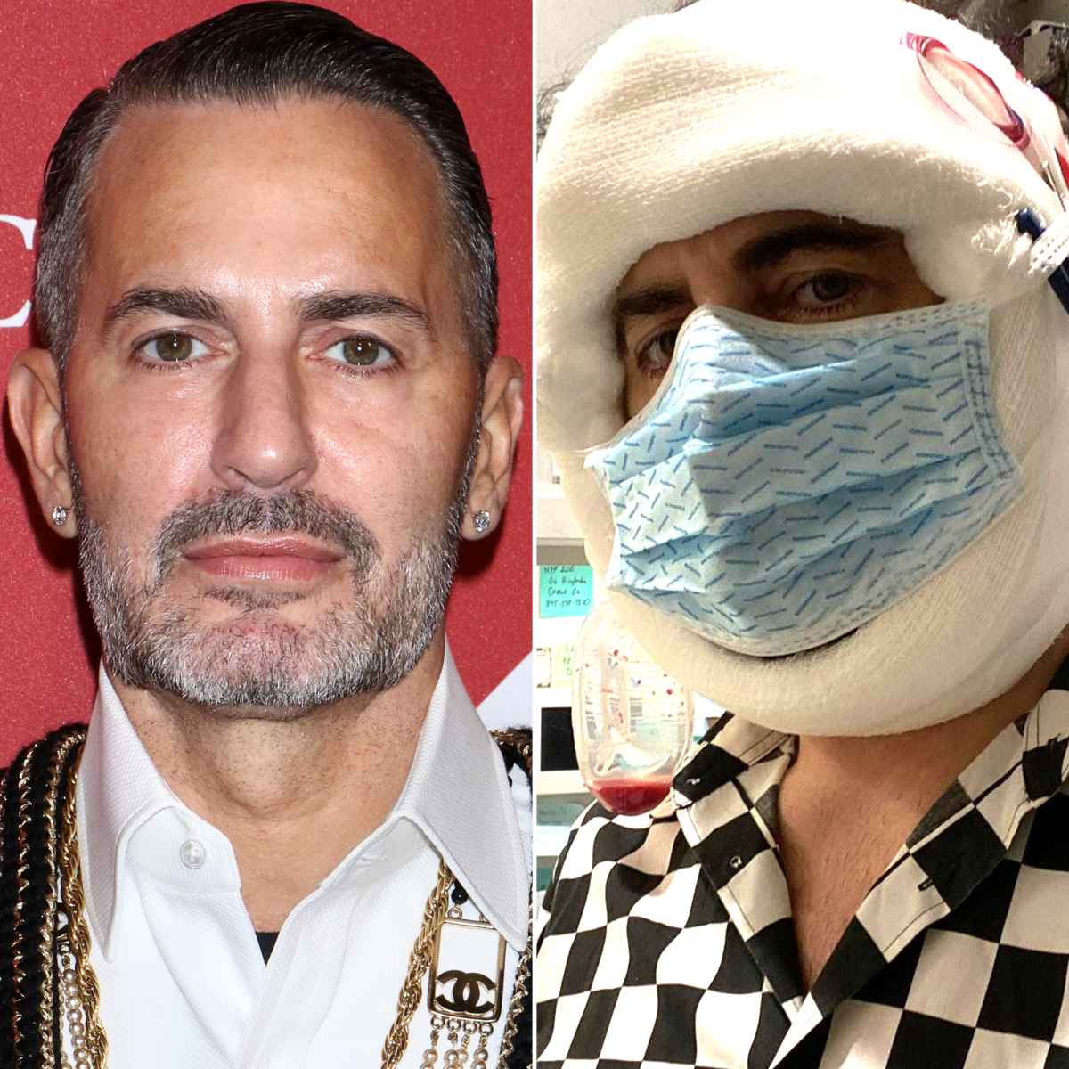 Marc Jacobs reveals results of facelift