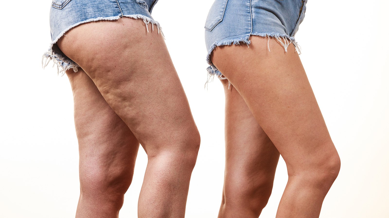 Best anti-cellulite cream for 2019 - How to get rid of cellulite