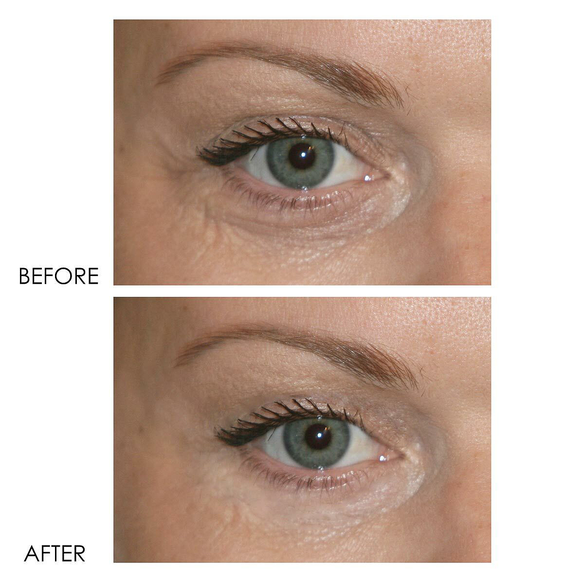 dermelect-eye-cream-before-after