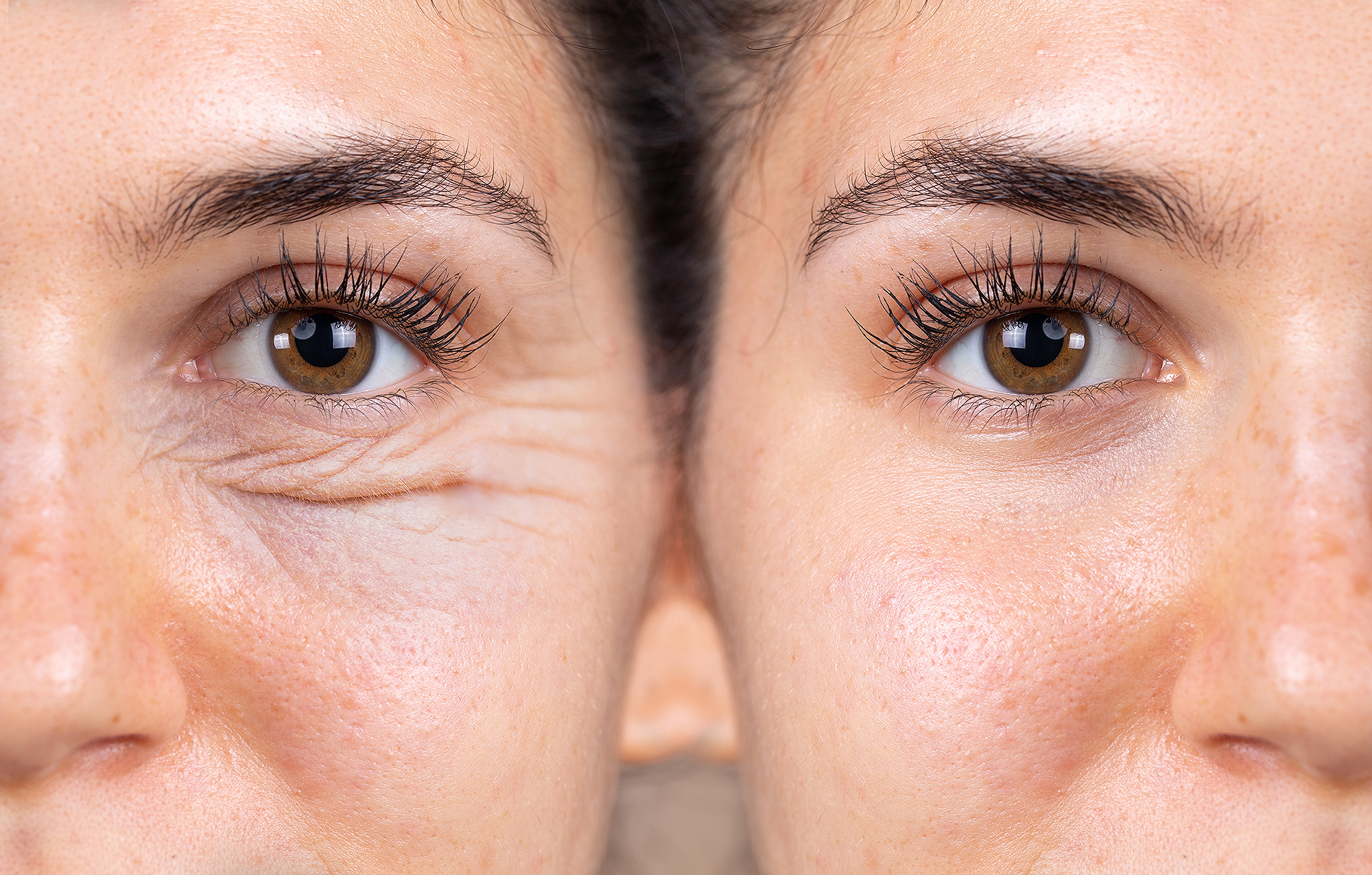 How to Get Rid of Puffy Eyes  Bags Under Eyes