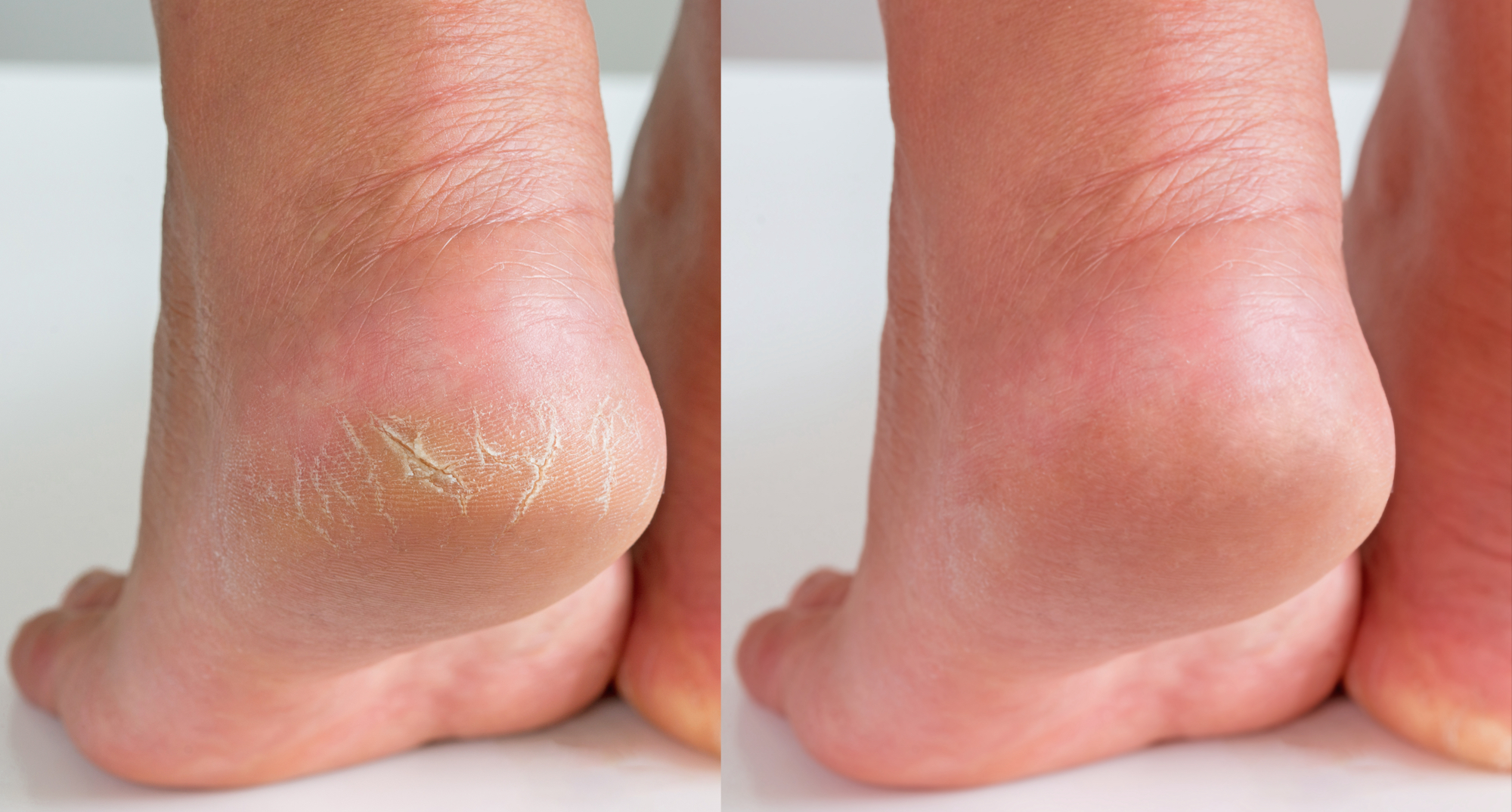 8 remedies for cracked heels and what causes them | GoodtoKnow