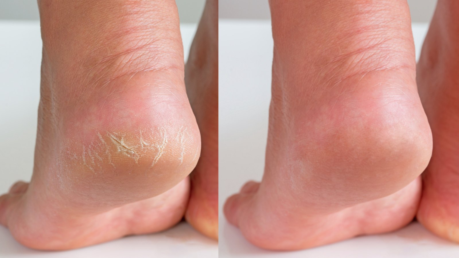 OLD DRY SKIN AND CRACKED HEEL REMOVAL BY MISS FOOT FIXER 