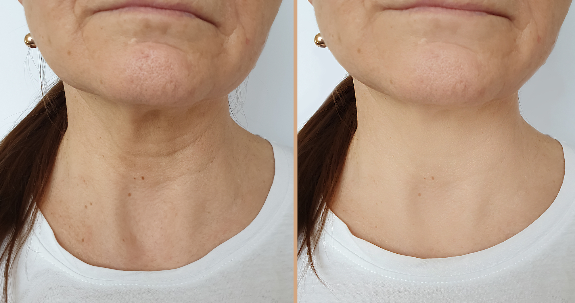 Does Neck Skin Age More Quickly? What Experts Say - The New York Times