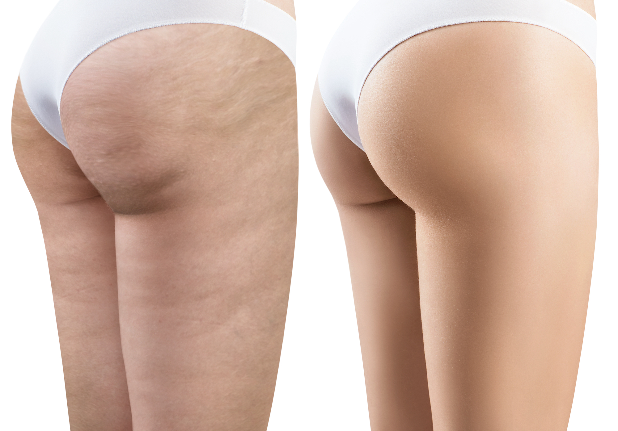 Best exercise 2024 for thigh cellulite