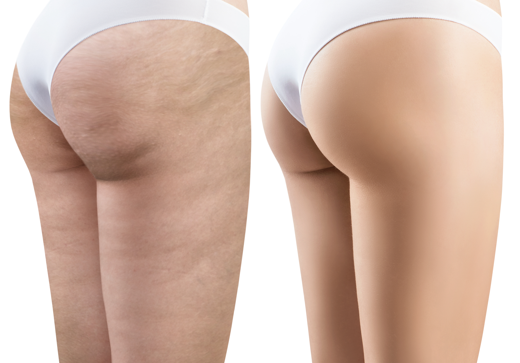 Cellulite Relief Massage: Legs, Bum, Tum