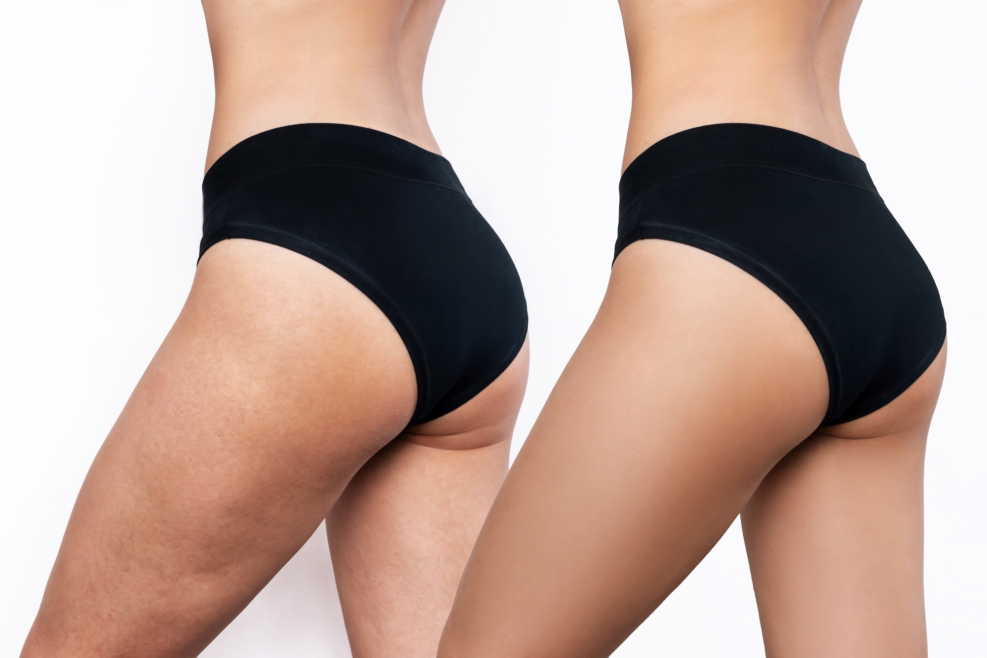 What's the Most Effective Anti Cellulite Treatment?