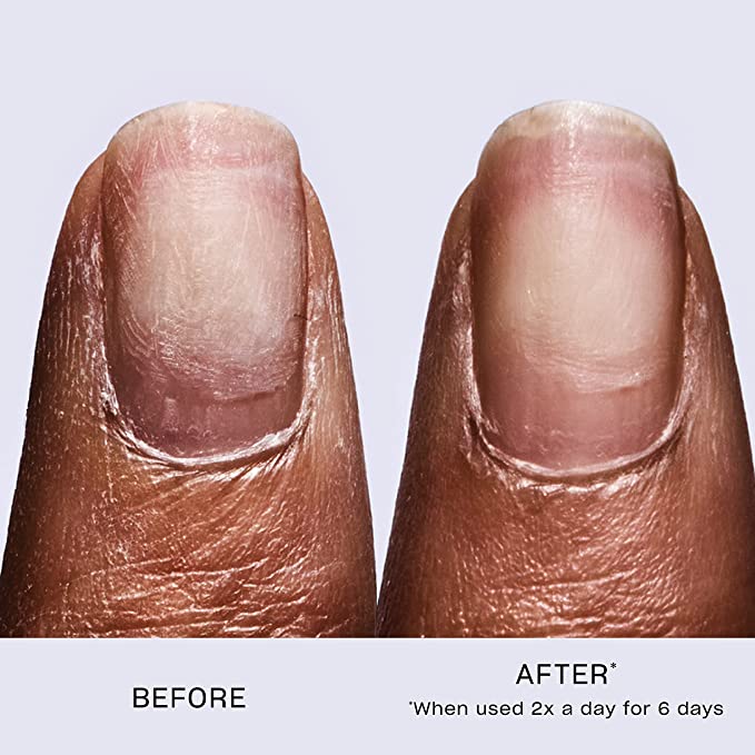 nail fungus treatment / nail treatments for damaged nails/ best nail  treatment at Rs 699/pack in Haridwar