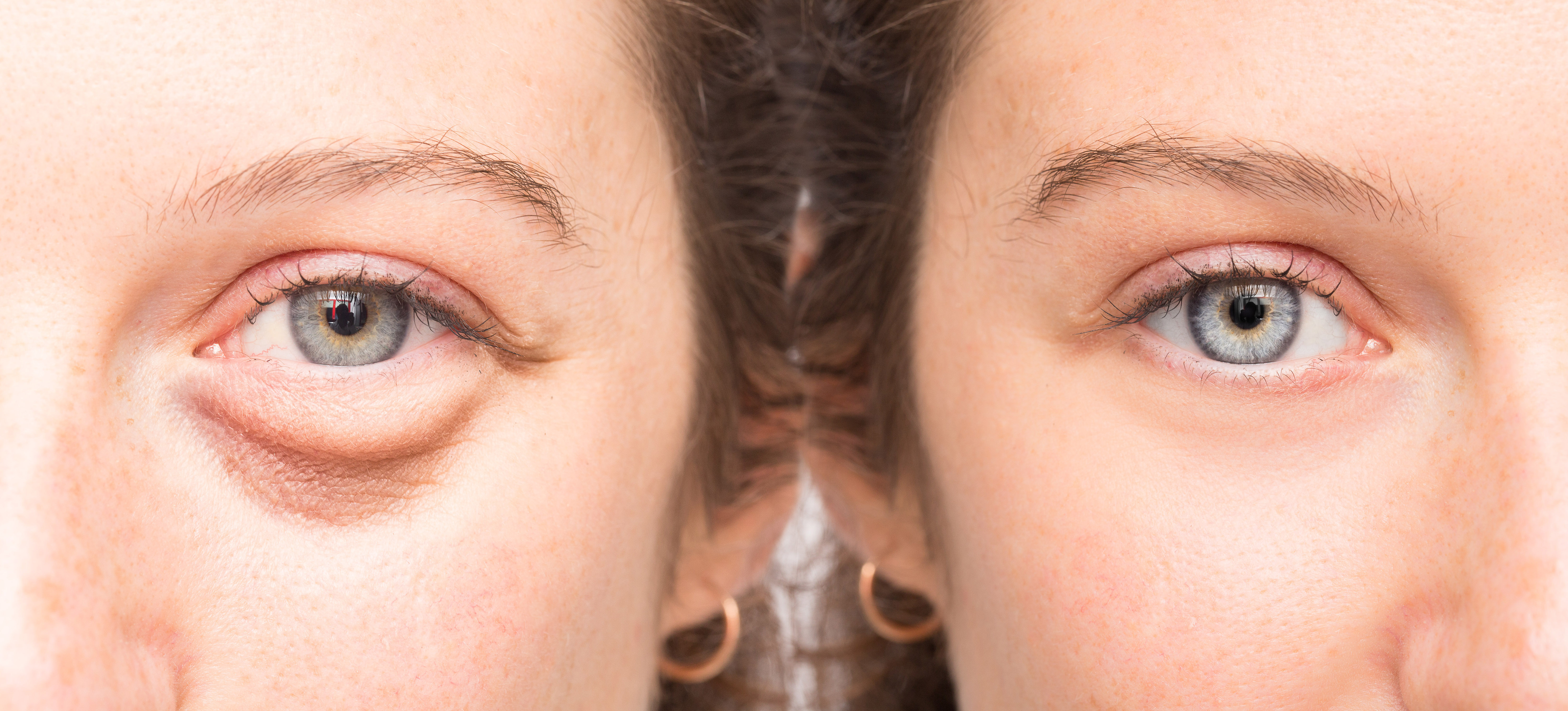 Can I Reduce My Eye Bags Naturally or Do I Need Surgery