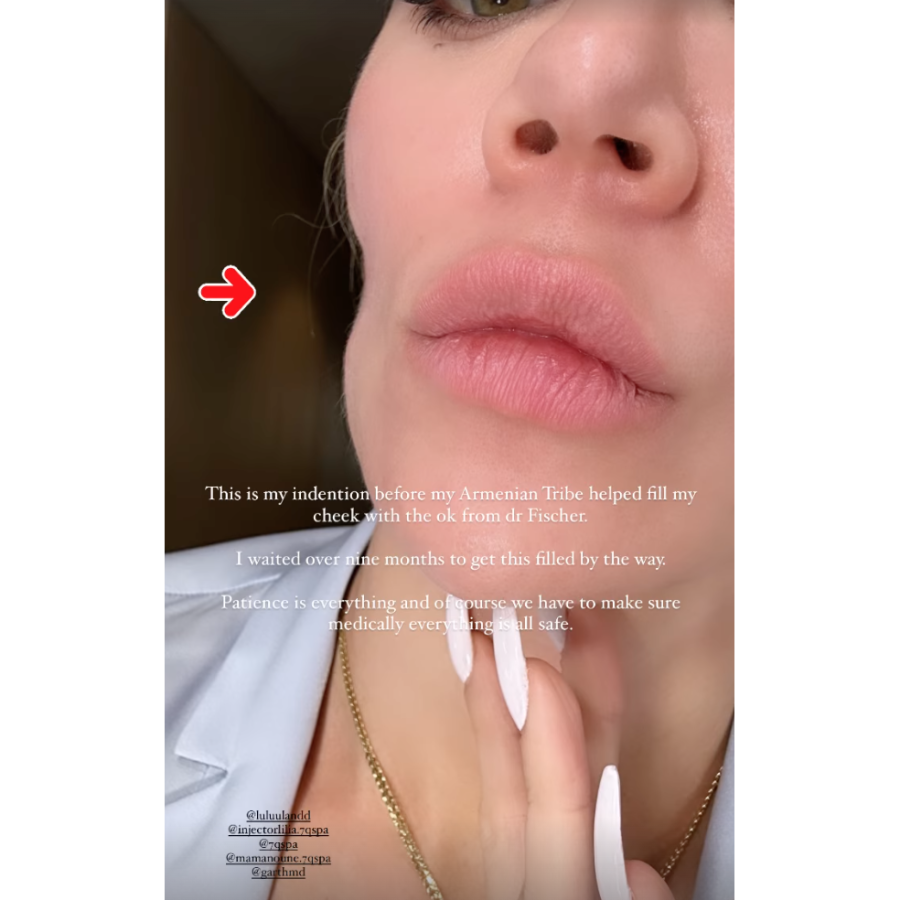 Khloe Kardashian Reveals Photos of Her Cheek Indentation Post Cancer