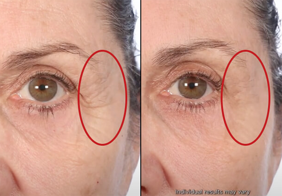 Serious Skincare Trace + Erase: 100% Saw Fewer Wrinkles