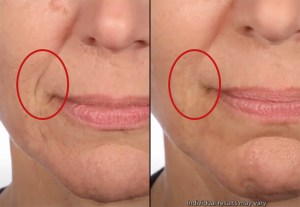 serious-skincare-trace-erase-smile-lines