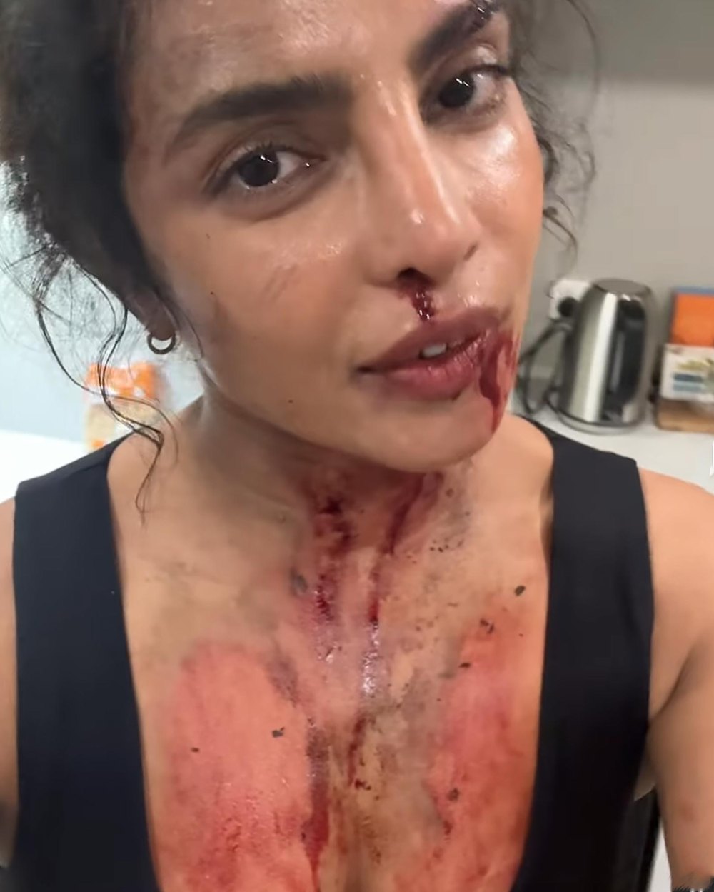 Priyanka Chopra Bruised and Bloodied on the Sets of New Movie