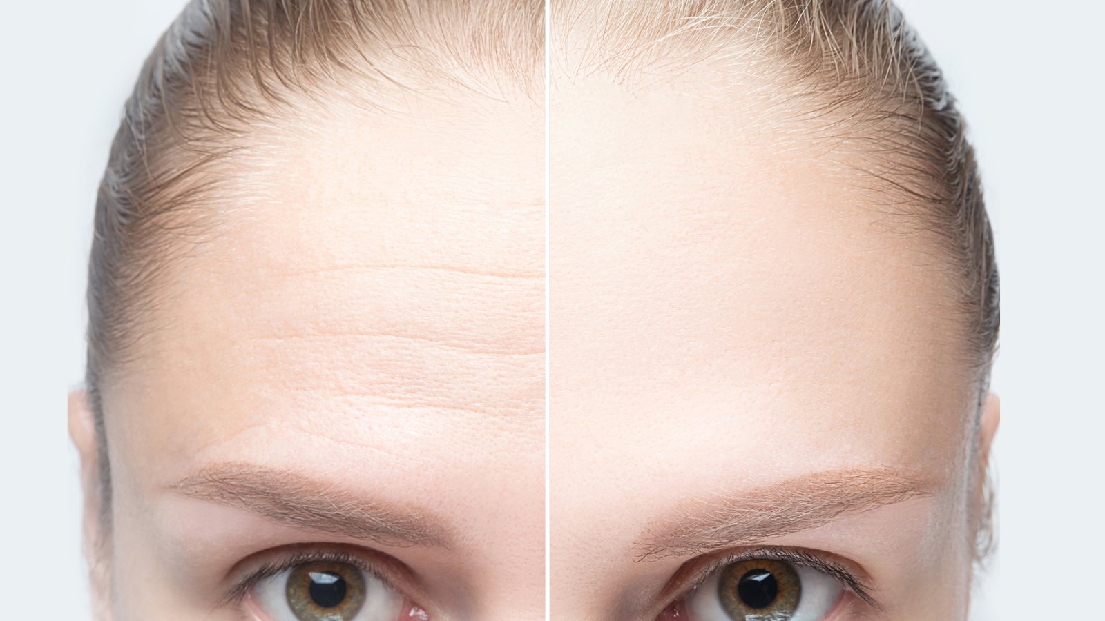 Forehead wrinkles before and after injection, treatment, surgery. Womans face close up.