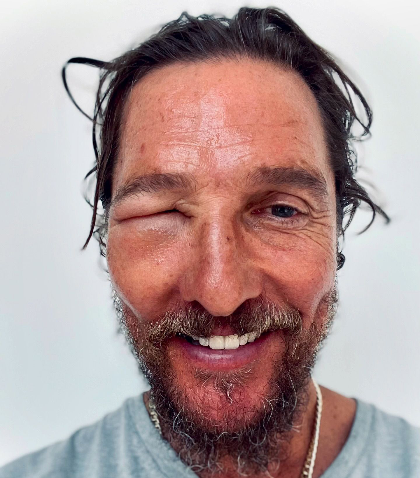 O olho de Matthew McConaughey está inchado e fechado após picada de abelha