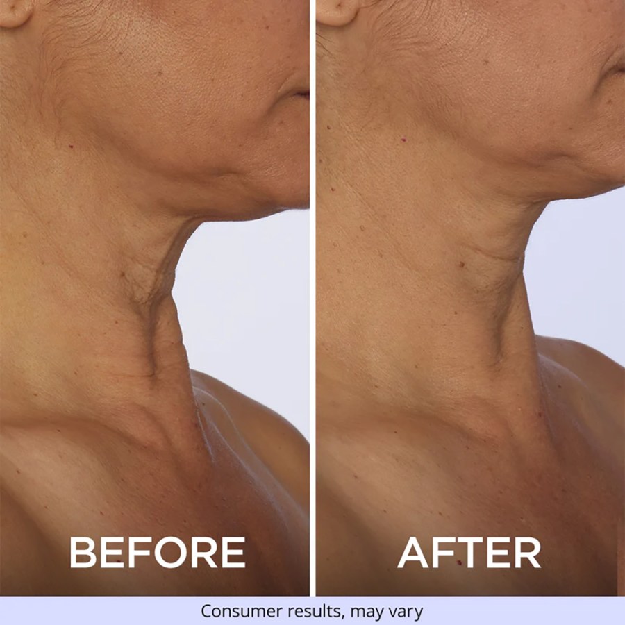 gopure-neck-cream-before-after