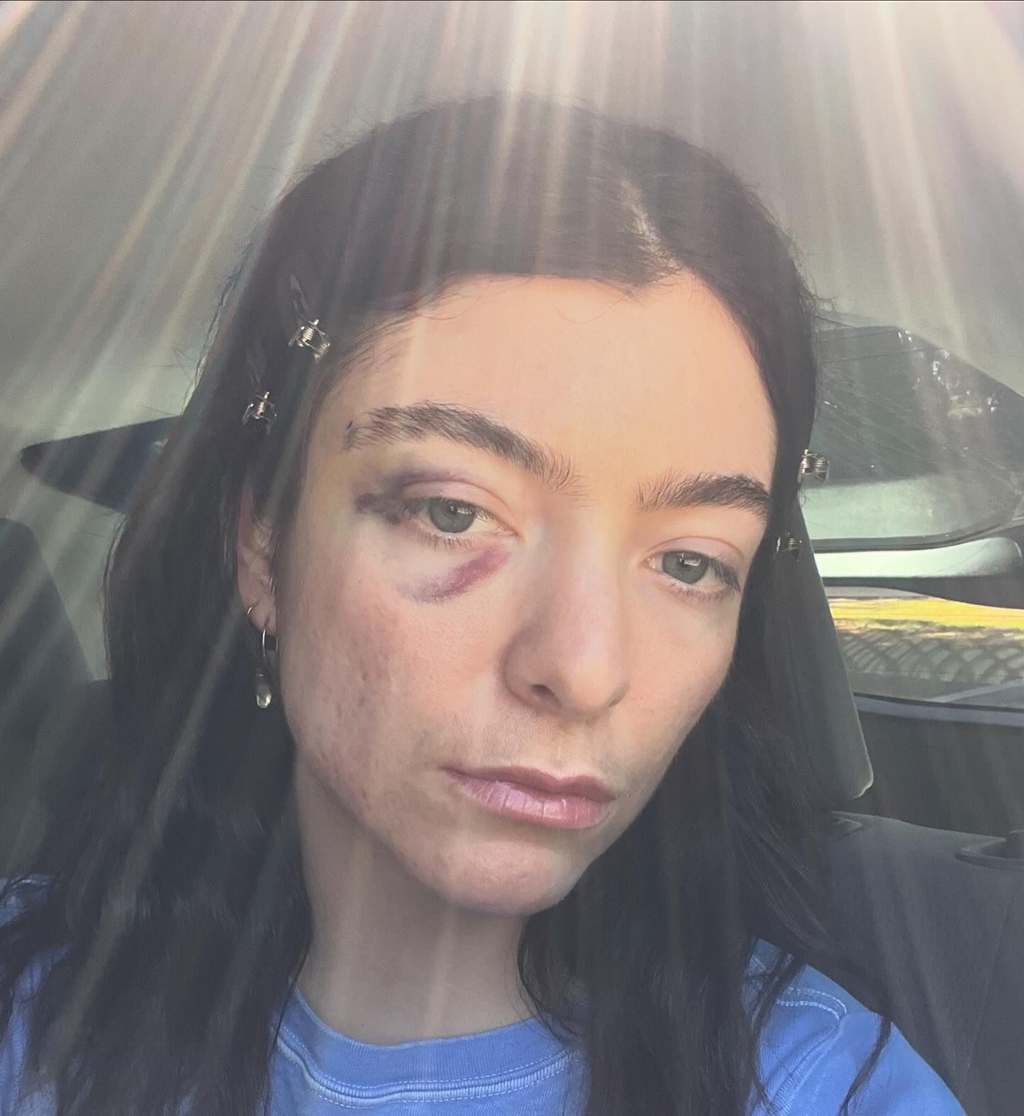 Lorde Deletes Everything From Her Instagram Except New Black Eye Photos