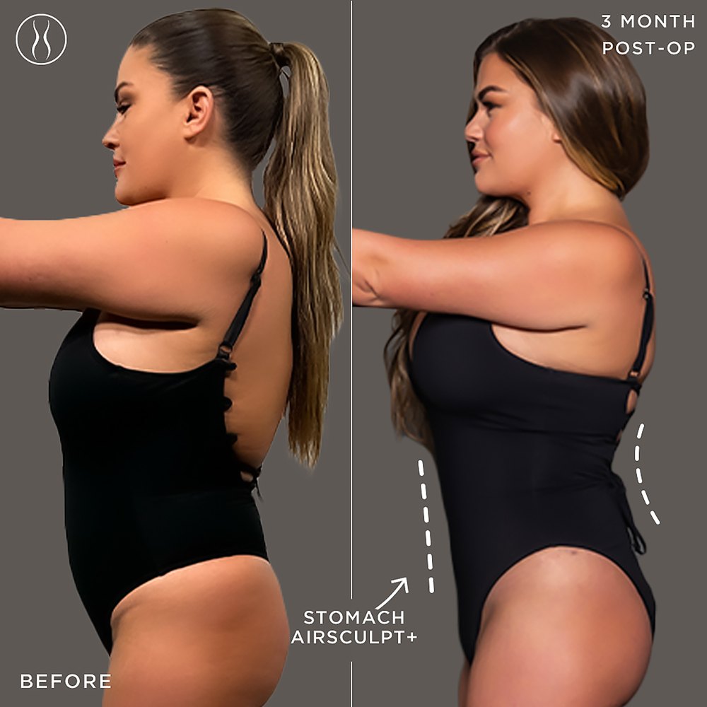 Vea las fotos de antes y después de AirSculpt de Brittany Cartwright. merezco sentirme bien