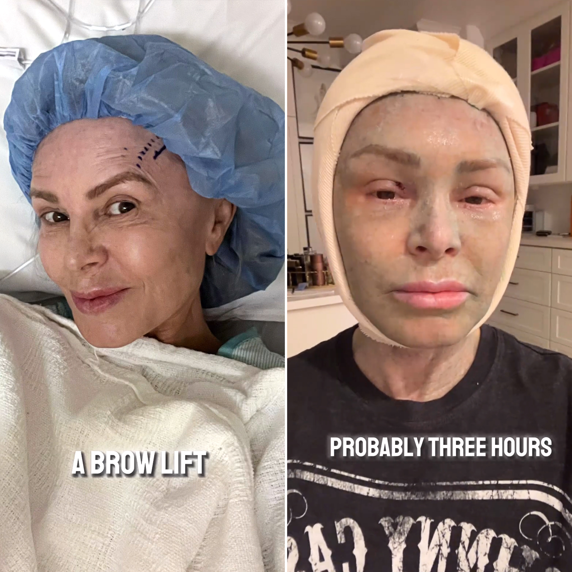 RHOC’s Tamra Judge Gets a Brow Lift: ‘Let the Healing Begin’