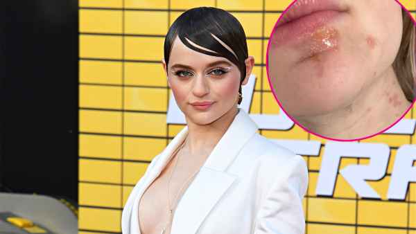 Joey King reveals burns she sustained to her face