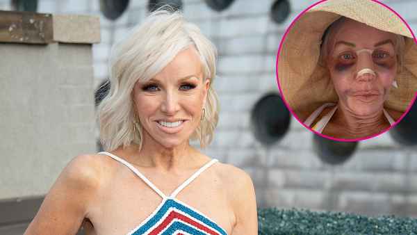 Margaret Josephs 58 Shows Off Nose Job Results After Being Bruised and Bandaged