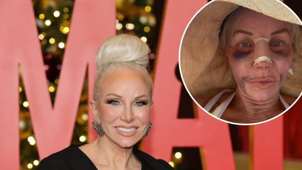 Real Housewives of New Jersey's Margaret Josephs Details 'Brutal' Bruising After Secret Nose Job